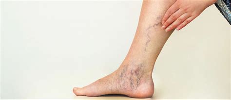 Este posibil să faci ghemuțe cu vene varicoase la nivelul gambei